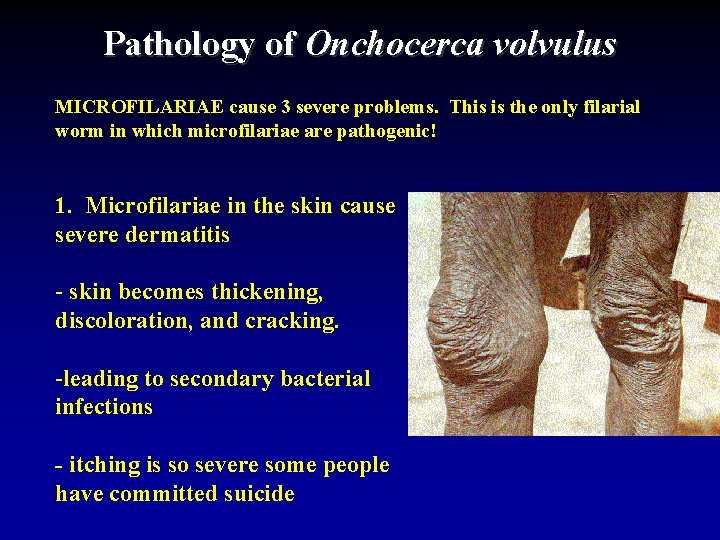 Pathology of Onchocerca volvulus MICROFILARIAE cause 3 severe problems. This is the only filarial