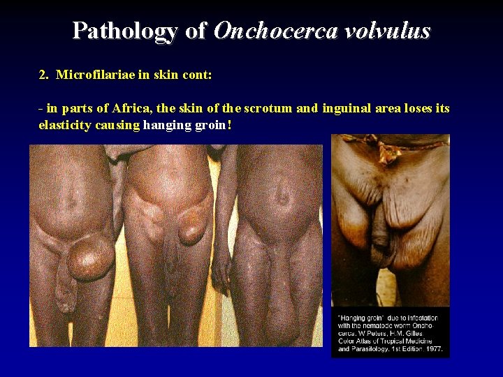 Pathology of Onchocerca volvulus 2. Microfilariae in skin cont: - in parts of Africa,