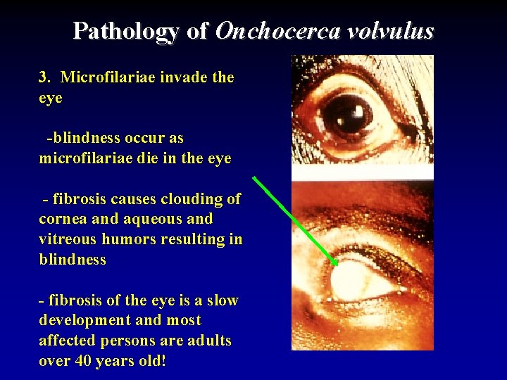 Pathology of Onchocerca volvulus 3. Microfilariae invade the eye -blindness occur as microfilariae die