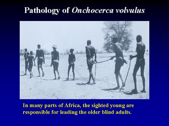 Pathology of Onchocerca volvulus In many parts of Africa, the sighted young are responsible