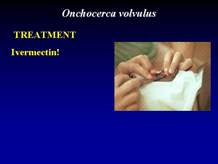 Onchocerca volvulus TREATMENT Ivermectin! 