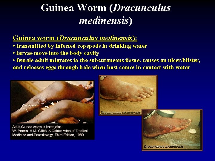 Guinea Worm (Dracunculus medinensis) Guinea worm (Dracunculus medinensis): • transmitted by infected copepods in