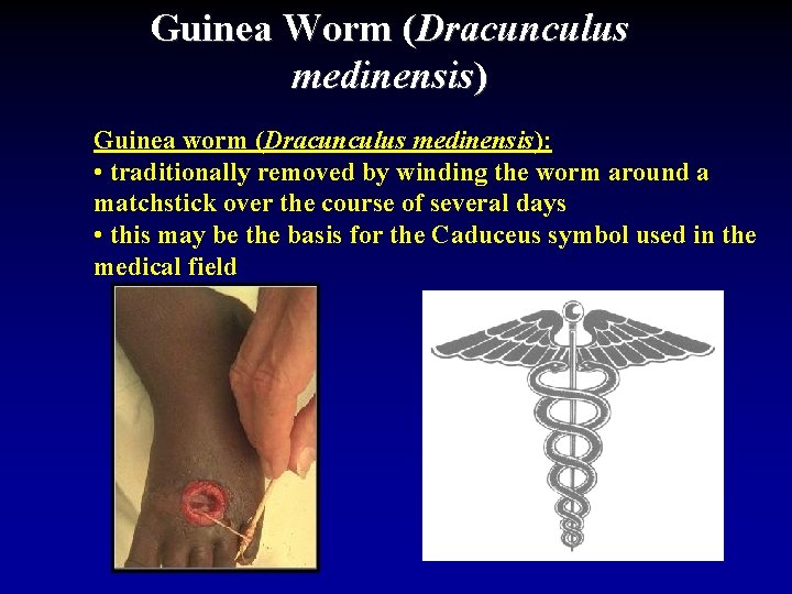 Guinea Worm (Dracunculus medinensis) Guinea worm (Dracunculus medinensis): • traditionally removed by winding the