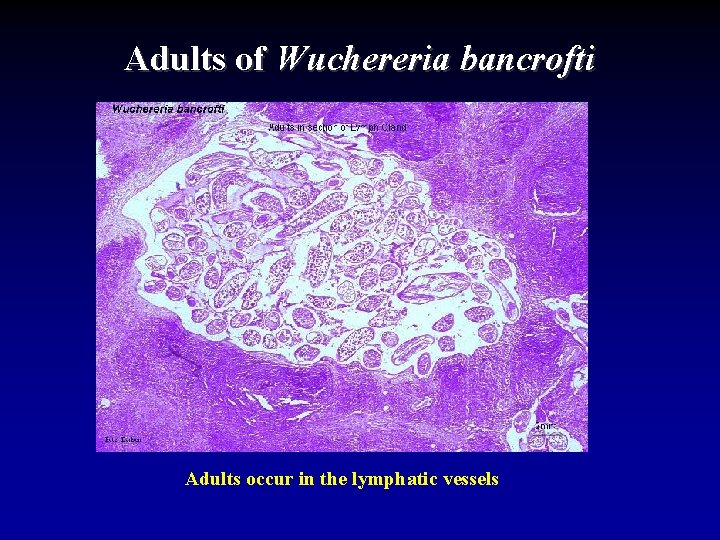 Adults of Wuchereria bancrofti Adults occur in the lymphatic vessels 