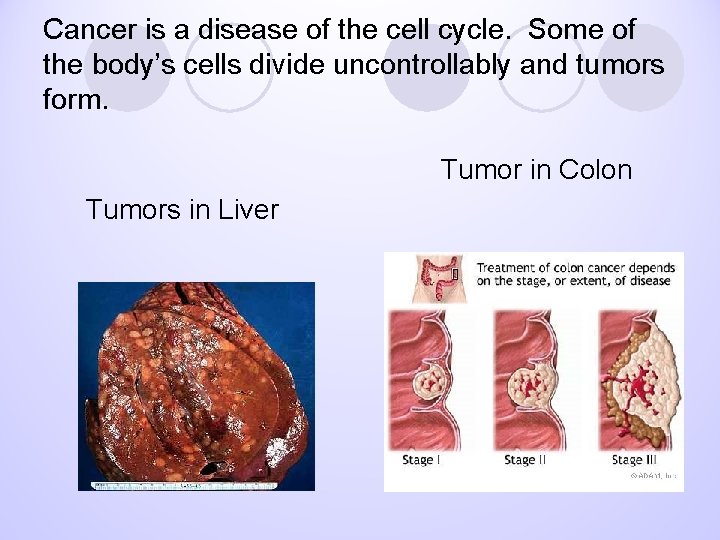 Cancer is a disease of the cell cycle. Some of the body’s cells divide