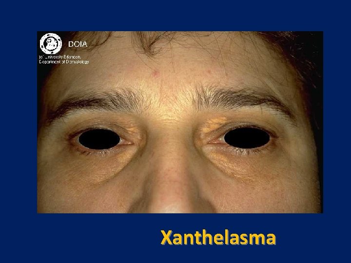 Xanthelasma 