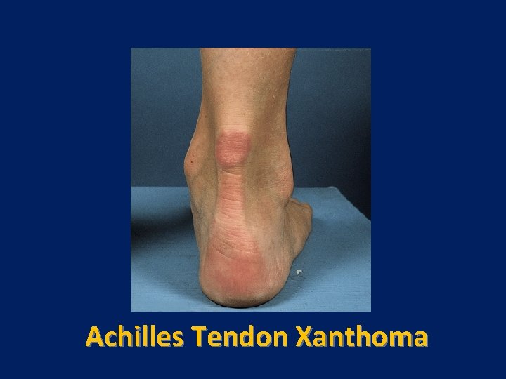 Achilles Tendon Xanthoma 