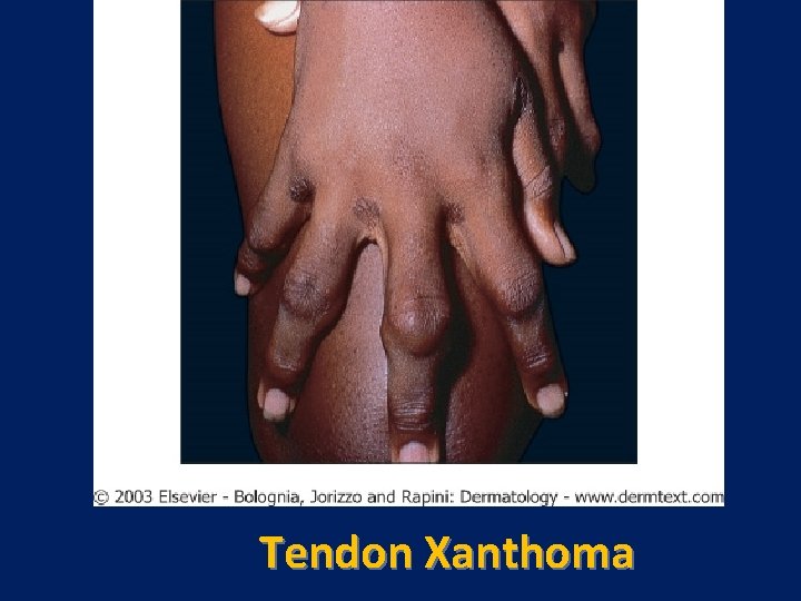 Tendon Xanthoma 