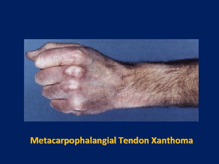 Metacarpophalangial Tendon Xanthoma 