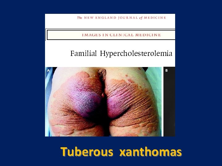 Tuberous xanthomas 