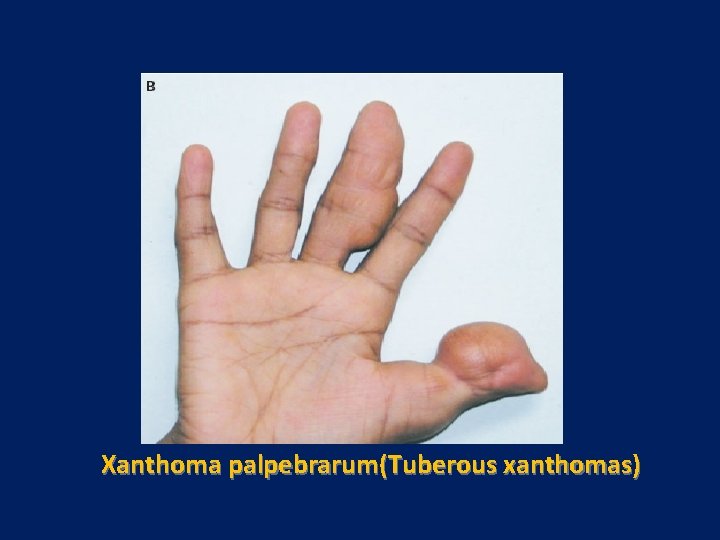 Xanthoma palpebrarum(Tuberous xanthomas) 