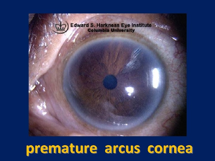 premature arcus cornea 