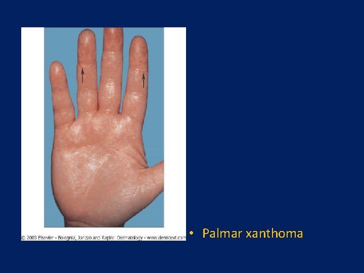  • Palmar xanthoma 