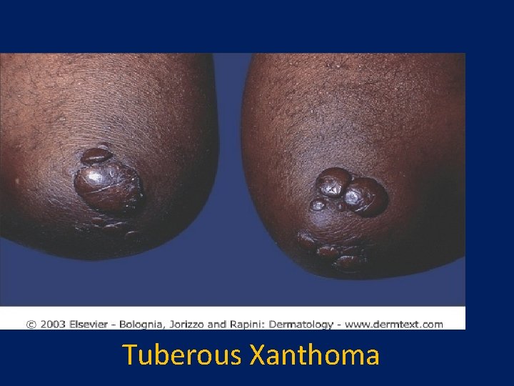 Tuberous Xanthoma 