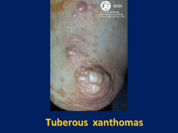 Tuberous xanthomas 