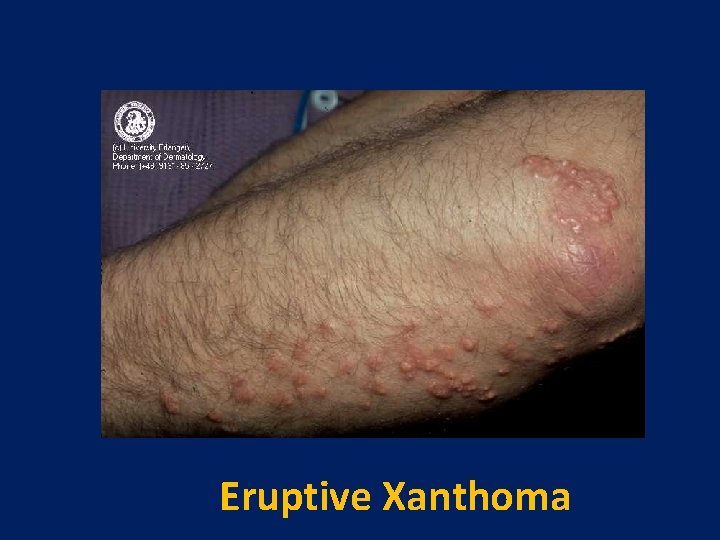 Eruptive Xanthoma 