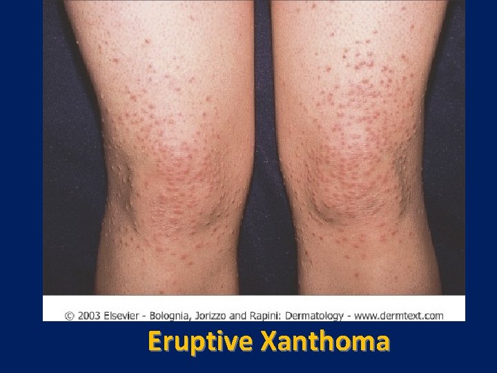 Eruptive Xanthoma 