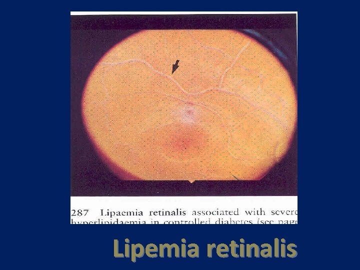 Lipemia retinalis 