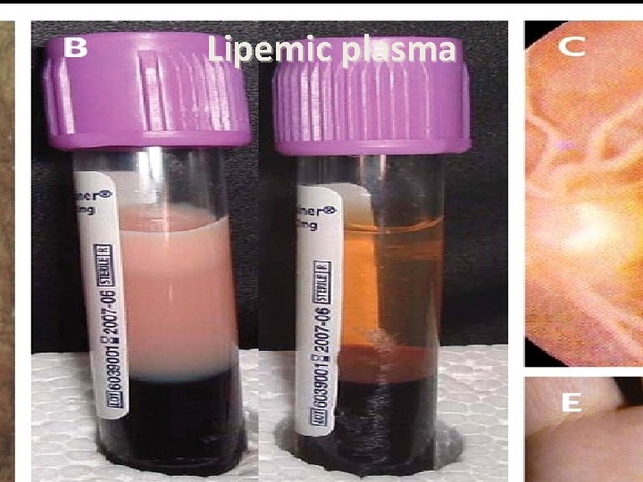 Lipemic plasma 