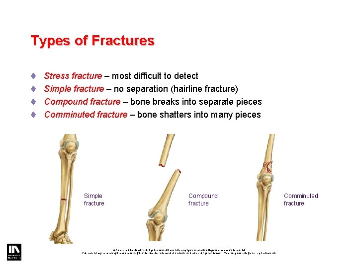 Types of Fractures t Stress fracture – most difficult to detect t Simple fracture Types of Fractures t Stress fracture – most difficult to detect t Simple fracture