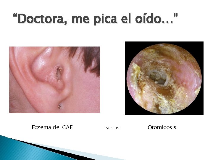 “Doctora, me pica el oído…” Eczema del CAE versus Otomicosis 