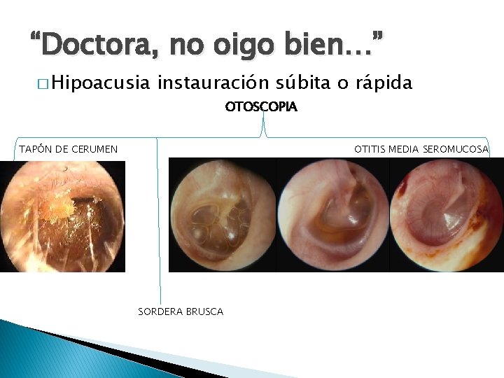 “Doctora, no oigo bien…” � Hipoacusia instauración súbita o rápida OTOSCOPIA TAPÓN DE CERUMEN