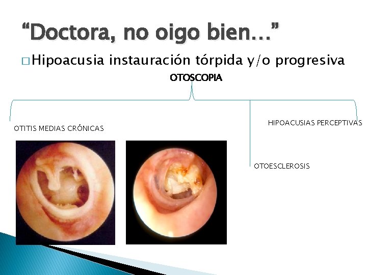 “Doctora, no oigo bien…” � Hipoacusia instauración tórpida y/o progresiva OTOSCOPIA OTITIS MEDIAS CRÓNICAS