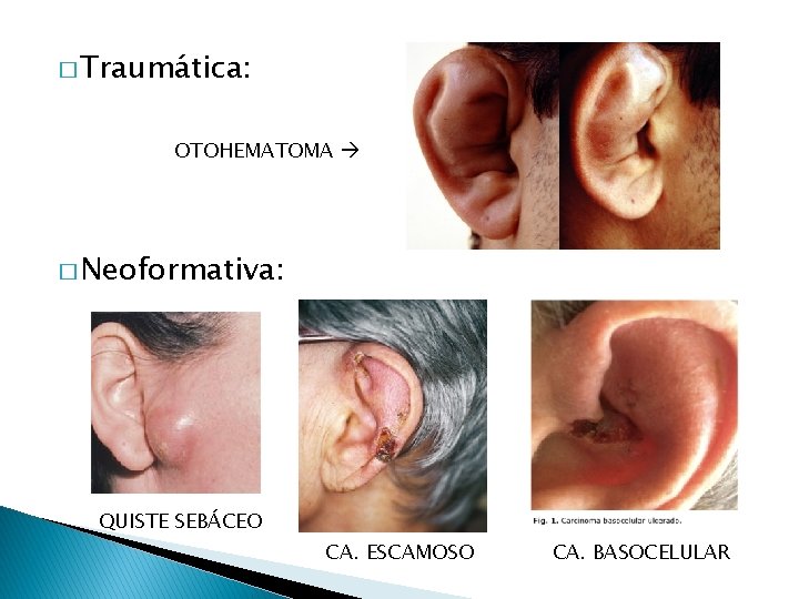 � Traumática: OTOHEMATOMA � Neoformativa: QUISTE SEBÁCEO CA. ESCAMOSO CA. BASOCELULAR 