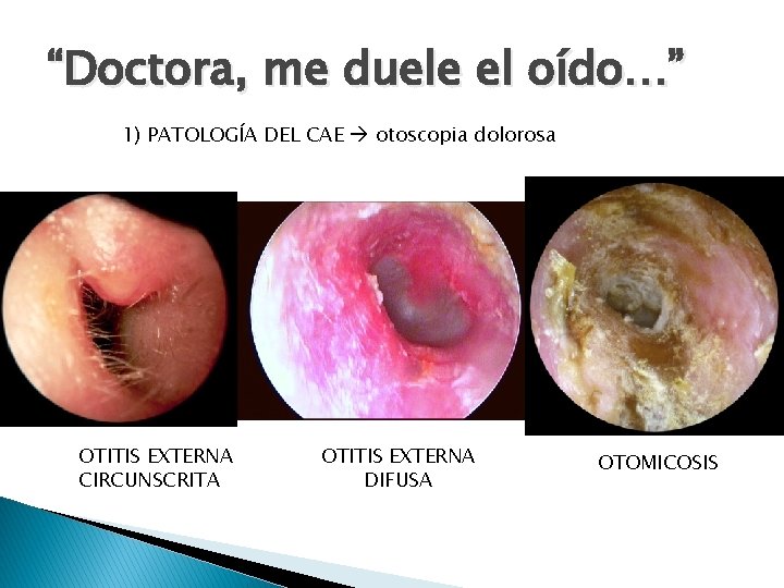“Doctora, me duele el oído…” 1) PATOLOGÍA DEL CAE otoscopia dolorosa OTITIS EXTERNA CIRCUNSCRITA