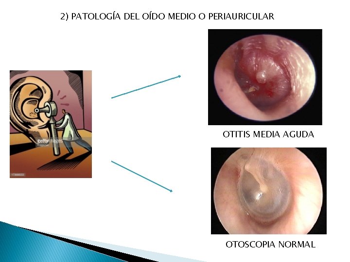 2) PATOLOGÍA DEL OÍDO MEDIO O PERIAURICULAR OTITIS MEDIA AGUDA OTOSCOPIA NORMAL 