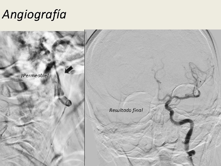 Angiografía ¡Permeable! Microcatéter Trombosis ACI Primer pase. . Desplegando trevo… Extracción Resultado final STENT
