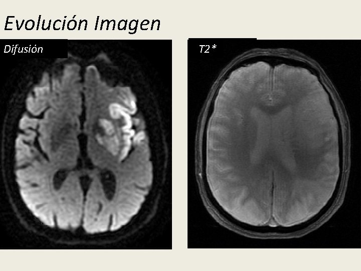 Evolución Imagen 24 h TT 2 Difusión 36 h FLAIR TT 2* 