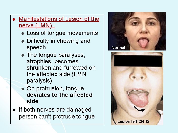 l l Manifestations of Lesion of the nerve (LMN) : l Loss of tongue