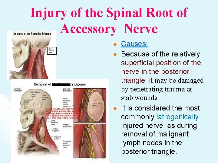 Injury of the Spinal Root of Accessory Nerve l l l Causes: Because of