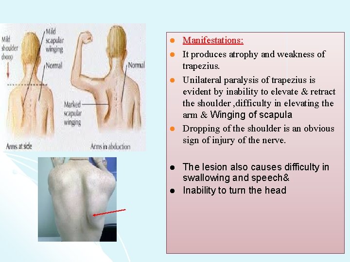 l l l Manifestations: It produces atrophy and weakness of trapezius. Unilateral paralysis of