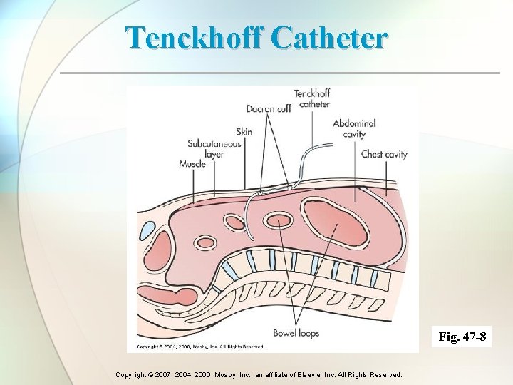 Tenckhoff Catheter Fig. 47 -8 Copyright © 2007, 2004, 2000, Mosby, Inc. , an