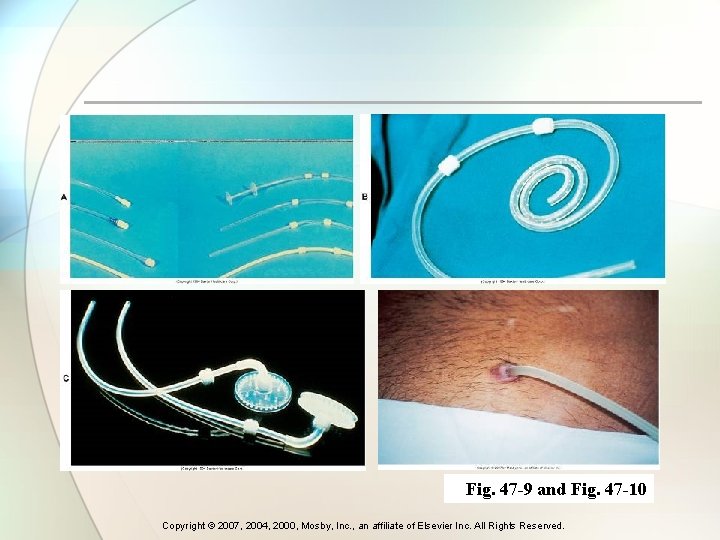 Fig. 47 -9 and Fig. 47 -10 Copyright © 2007, 2004, 2000, Mosby, Inc.