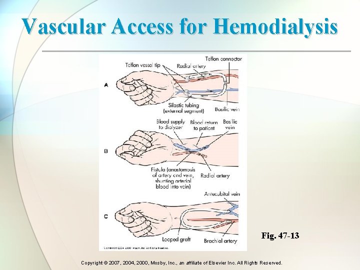 Vascular Access for Hemodialysis Fig. 47 -13 Copyright © 2007, 2004, 2000, Mosby, Inc.