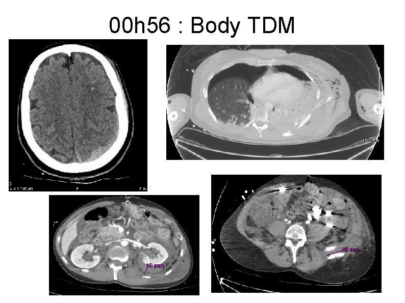 00 h 56 : Body TDM 