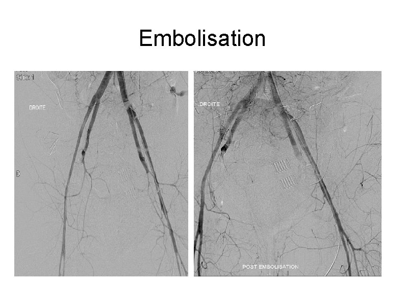 Embolisation 