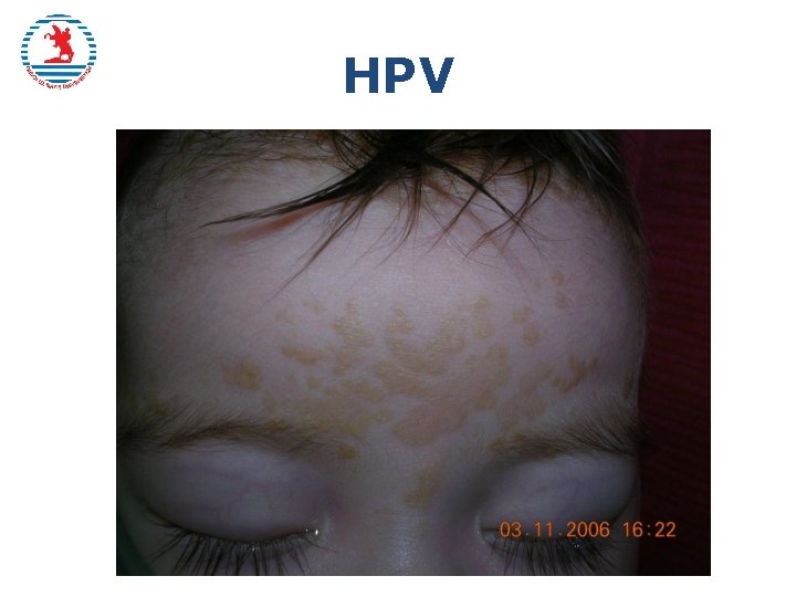 HPV 