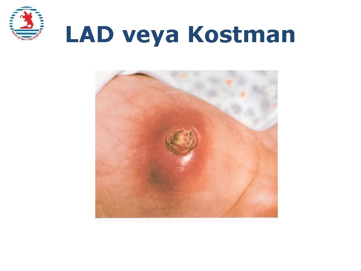 LAD veya Kostman 