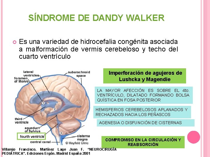 SÍNDROME DE DANDY WALKER Es una variedad de hidrocefalia congénita asociada a malformación de
