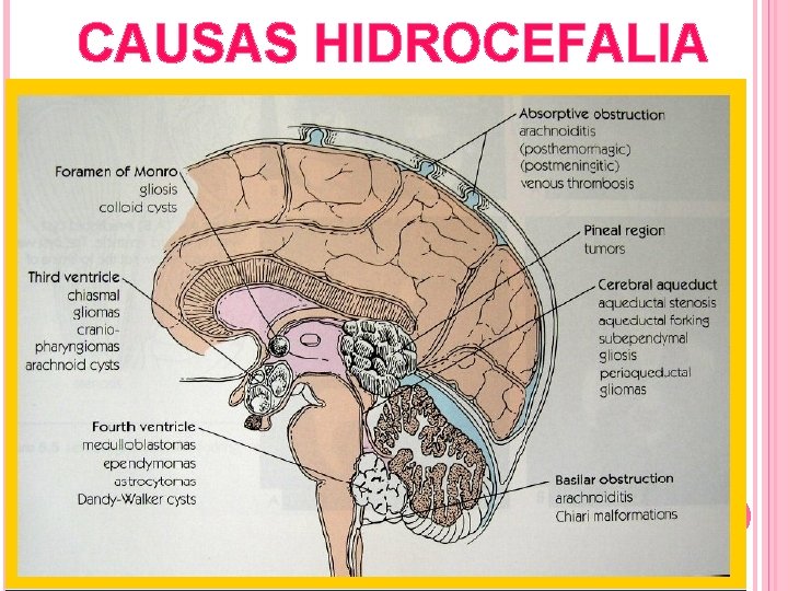 CAUSAS HIDROCEFALIA 