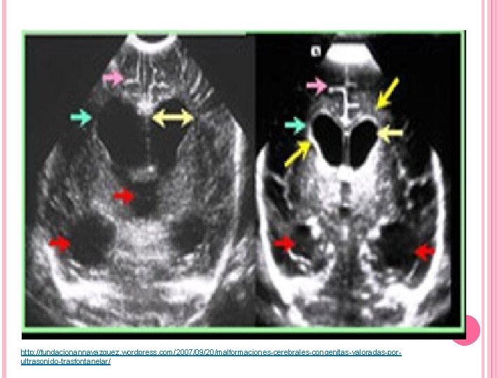 http: //fundacionannavazquez. wordpress. com/2007/09/20/malformaciones-cerebrales-congenitas-valoradas-porultrasonido-trasfontanelar/ 