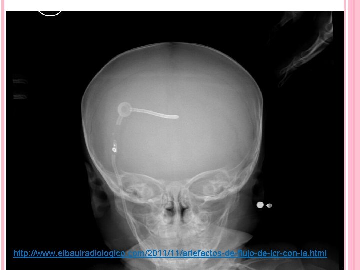 http: //www. elbaulradiologico. com/2011/11/artefactos-de-flujo-de-lcr-con-la. html 