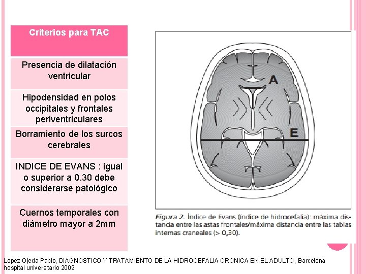 Criterios para TAC Presencia de dilatación ventricular Hipodensidad en polos occipitales y frontales periventriculares