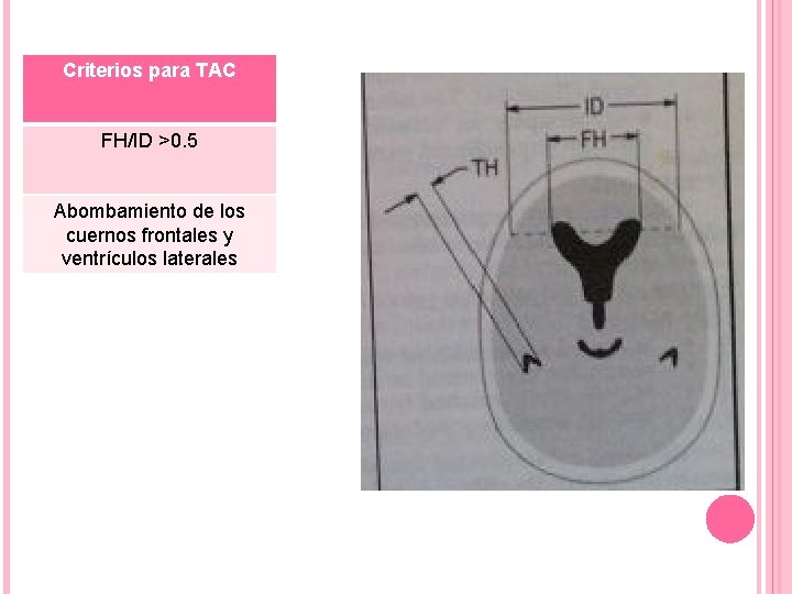 Criterios para TAC FH/ID >0. 5 Abombamiento de los cuernos frontales y ventrículos laterales