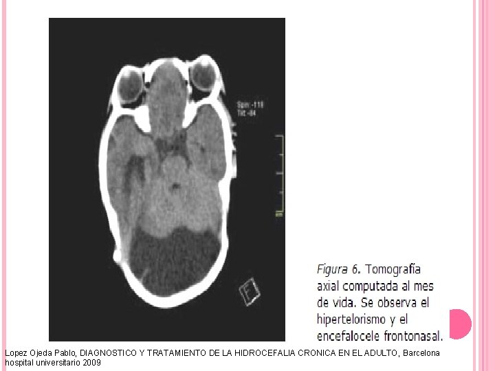 Lopez Ojeda Pablo, DIAGNOSTICO Y TRATAMIENTO DE LA HIDROCEFALIA CRONICA EN EL ADULTO, Barcelona