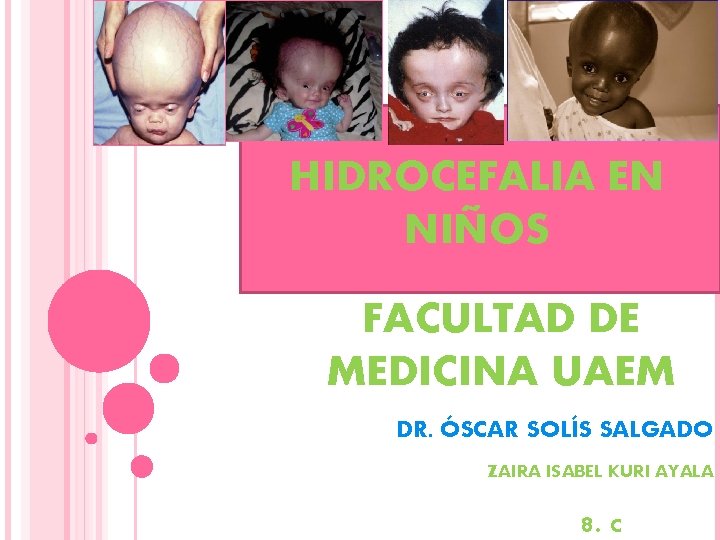 HIDROCEFALIA EN NIÑOS FACULTAD DE MEDICINA UAEM DR. ÓSCAR SOLÍS SALGADO ZAIRA ISABEL KURI